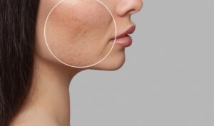 Say Goodbye to Acne Scars with Bellafill®: A Lasting Solution