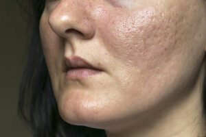 Say Goodbye to Acne Scars for Good with Bellafill® in Newport Beach, CA